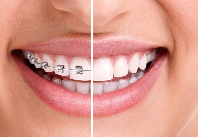 Aparaty na zęby - Ortodoncja Ząbki