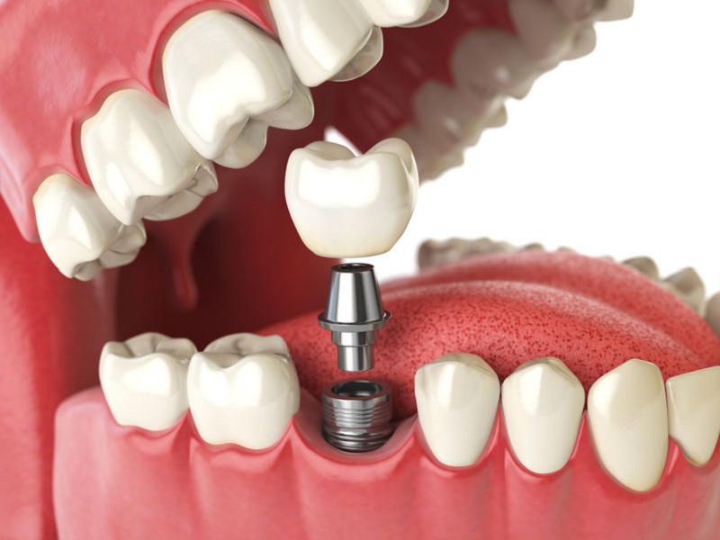 Implanty zębów Ząbki